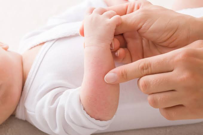Identifica la alergia alimentaria en bebés